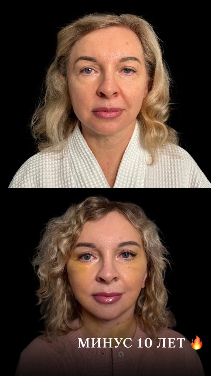 До и после — Блефаропластика